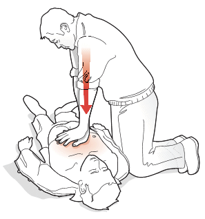 Massage cardiaque (Fédération Française de Cardiologie)