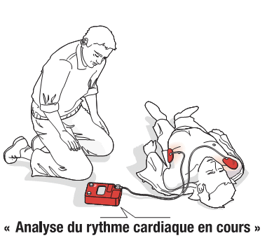 Défibrillation (Fédération Française de Cardiologie)